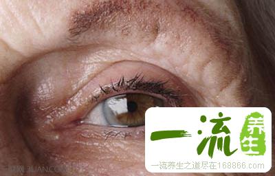 白内障的症状