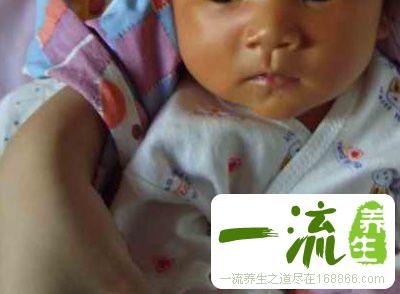 小儿黄疸 中医治疗黄疸有奇效