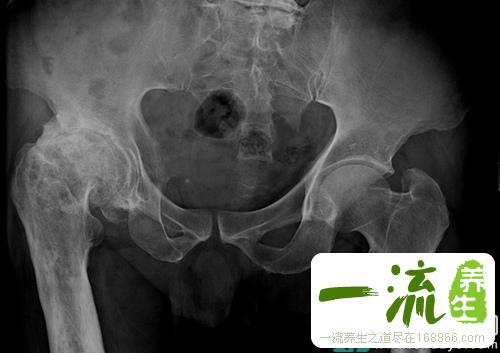 髋关节骨质增生有哪些表现
