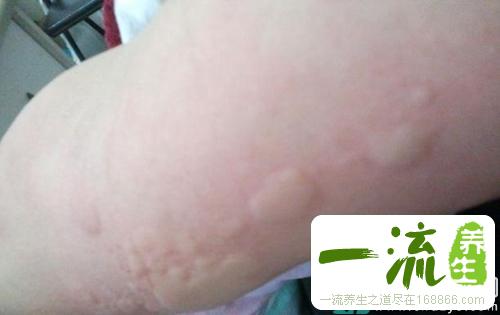 人工荨麻疹治疗方法