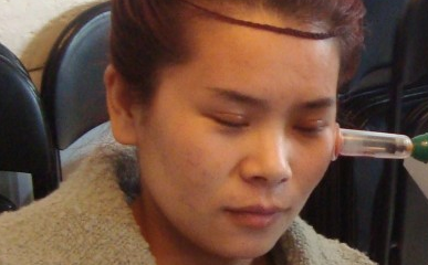 额头痘痘怎么快速祛除 怎么快速去痘痕