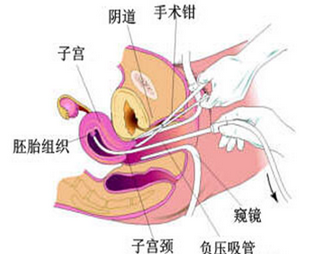 打胎是药流好还是人流好 药流与人流有哪些优缺点