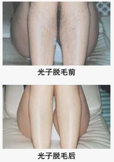 光子脱毛还会再长吗 光子脱毛会痛吗